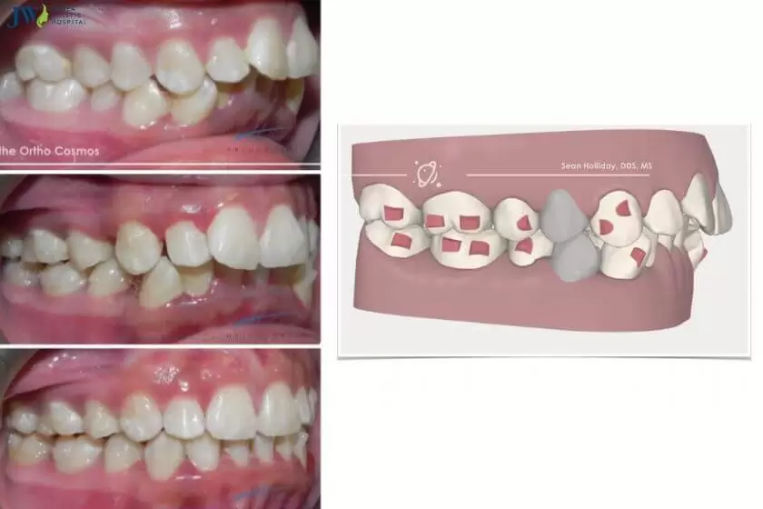 Có thật không: Niềng răng trong suốt AI không cần nhổ răng! 3
