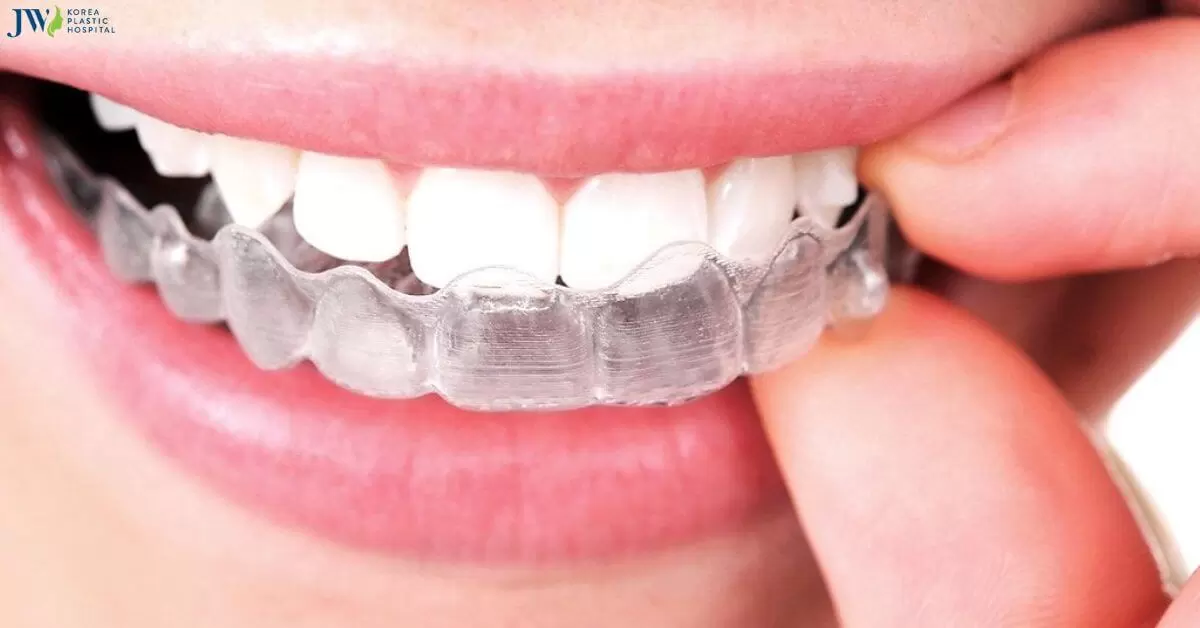 Có thật không: Niềng răng trong suốt AI không cần nhổ răng!