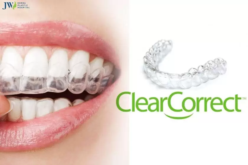 Những loại niềng răng trong suốt phổ biến nhất 3