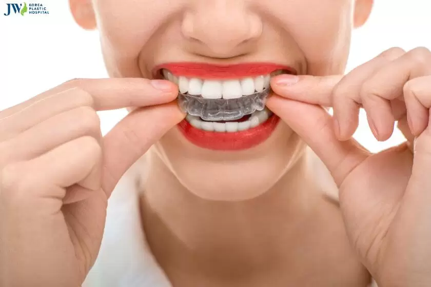 Niềng răng trong suốt AI: Khái niệm, cách hoạt động và điểm khác biệt 1