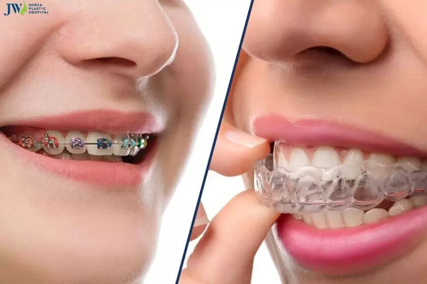 Niềng răng trong suốt AI: Khái niệm, cách hoạt động và điểm khác biệt 3