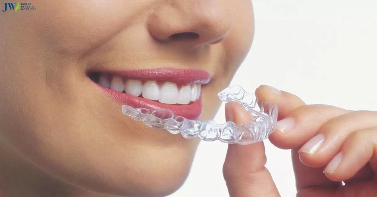 Niềng răng trong suốt AI: Khái niệm, cách hoạt động và điểm khác biệt