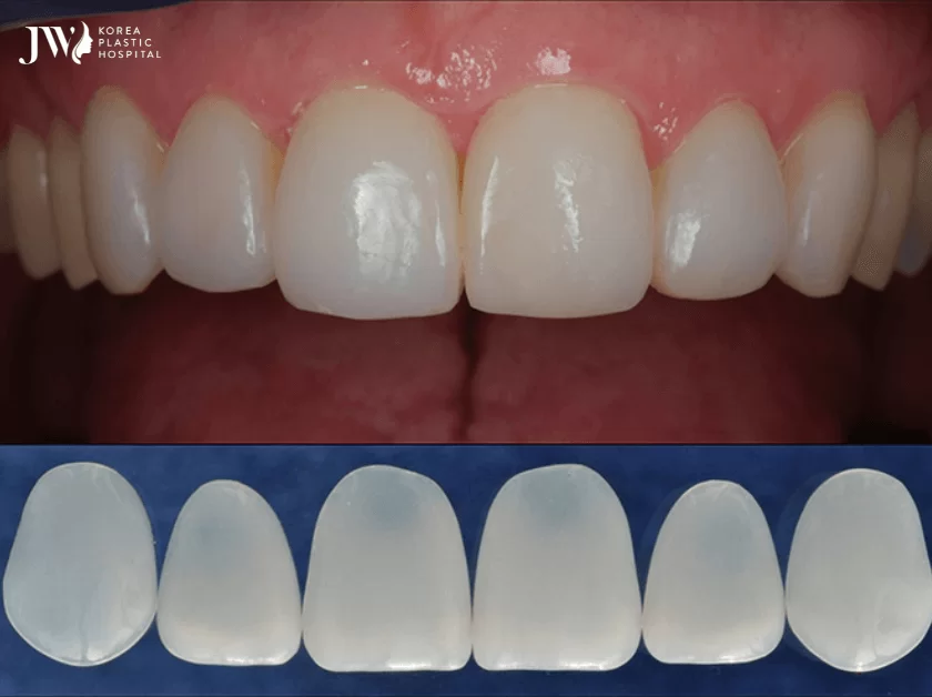 Răng sứ Veneer AI