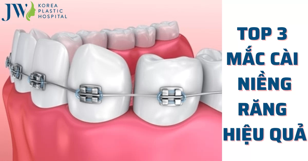 Các loại mắc cài niềng răng mang lại hiệu quả ngày nay