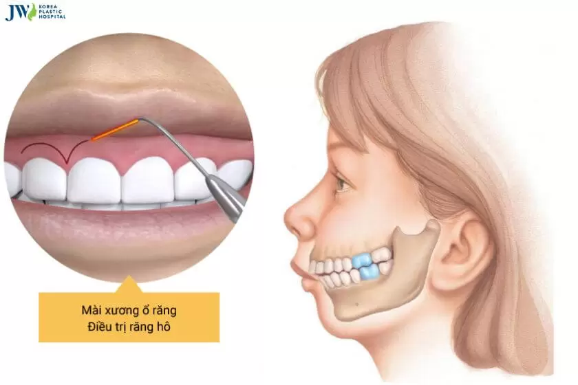 Tất tần tật về hô xương ổ răng: Khái niệm, ảnh hưởng, cách điều trị 2