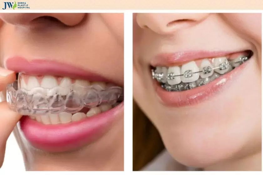 30 tuổi niềng răng được không