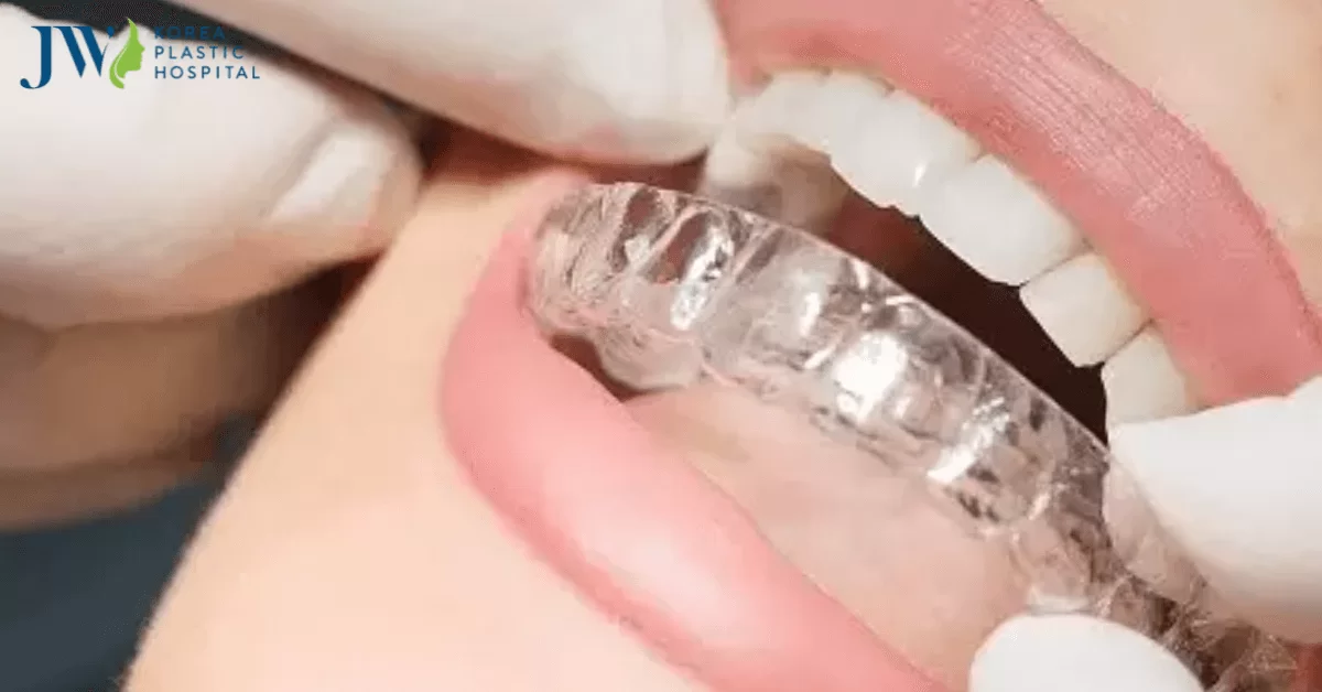 Quy trình đeo niềng răng trong suốt AI