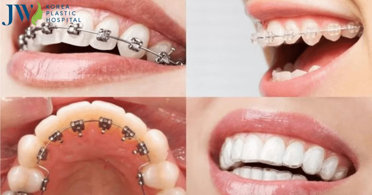 CÁC LOẠI NIỀNG RĂNG TRÊN THỊ TRƯỜNG HIỆN NAY