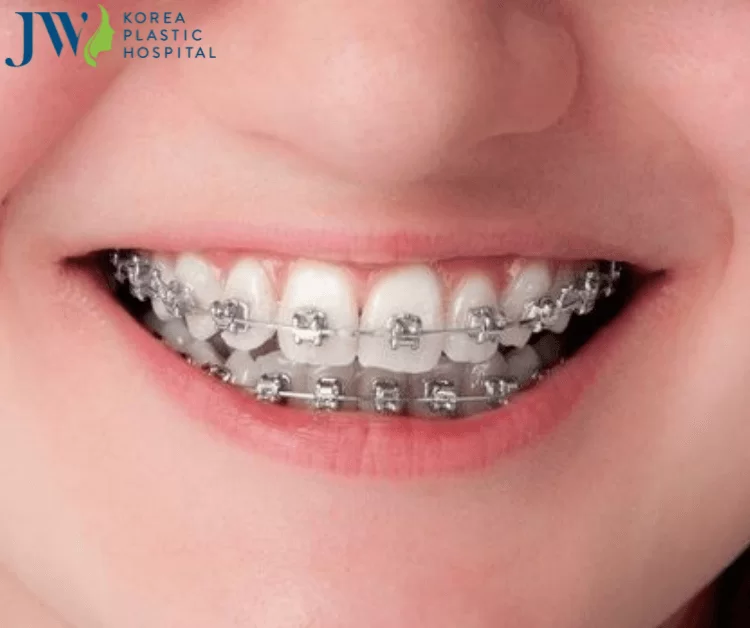 Bao nhiêu tuổi không được niềng răng nữa
