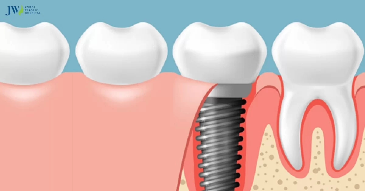 Công nghệ trồng răng Implant AI: Giải pháp hiện đại, an toàn và tiên tiến
