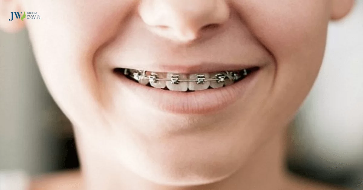 Giải pháp niềng răng là gì và một số lợi ích quan trọng 