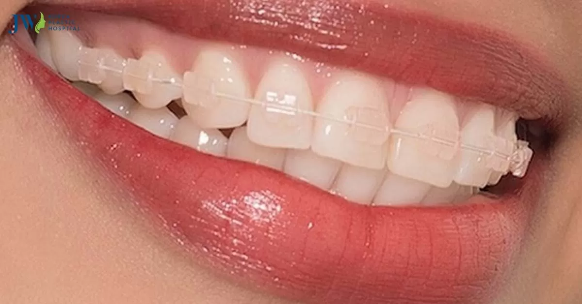Hướng dẫn sử dụng niềng răng trong suốt AI đúng cách và đạt hiệu quả
