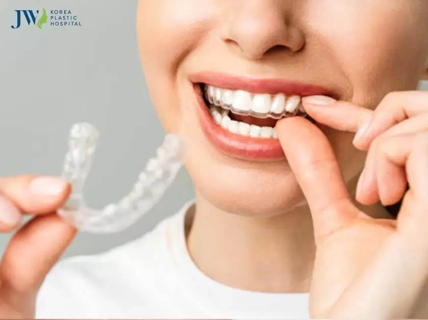 Niềng răng trong suốt AI dành cho trẻ em