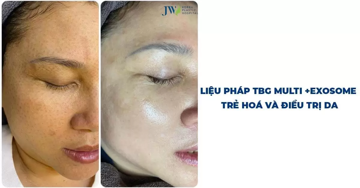 Multi+ Exosome: Liệu pháp và trẻ hóa làn da độc quyền tại JW 