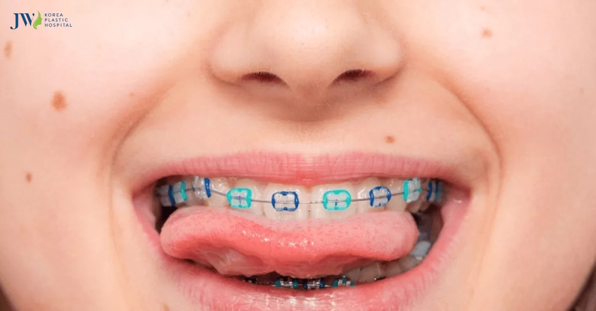 Lợi ích và rủi ro của việc niềng răng cho trẻ 9 tuổi