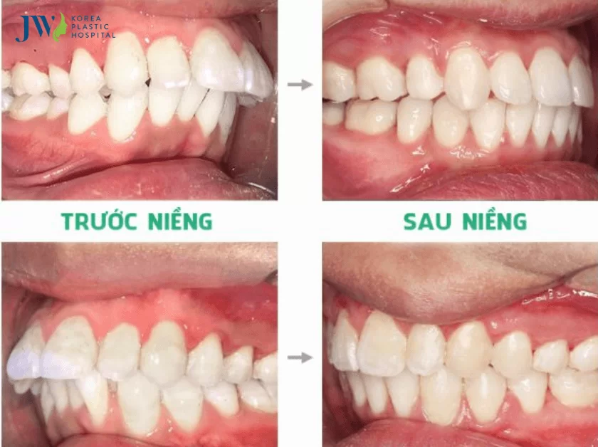 niềng răng khớp cắn sâu