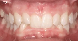 niềng răng khớp cắn sâu