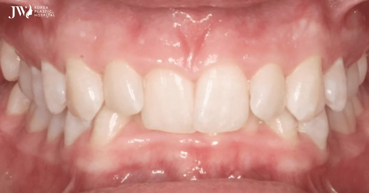 Quy trình niềng răng khớp cắn sâu