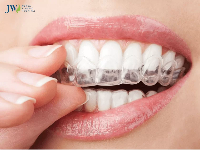 niềng răng khớp cắn sâu
