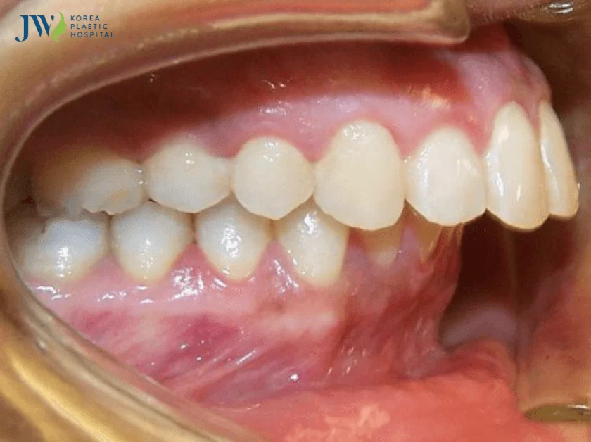 niềng răng khớp cắn sâu