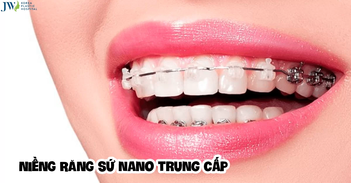 Niềng răng sứ Nano trung cấp và những điều cần lưu ý