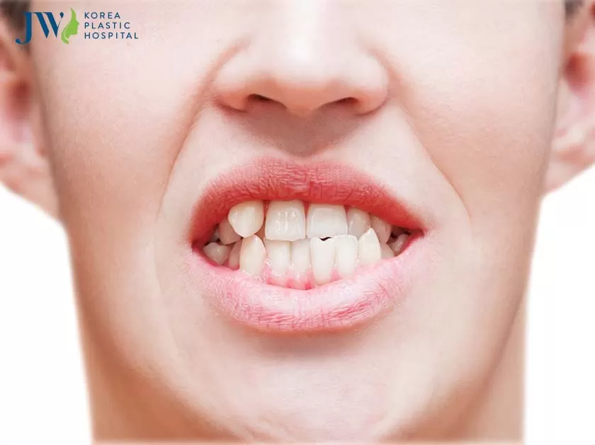 Niềng răng trong suốt AI làm răng đều đẹp
