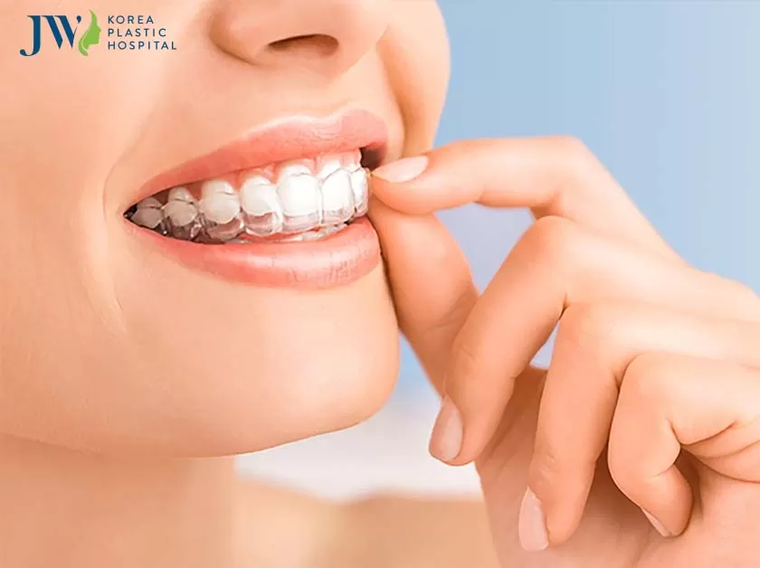 Niềng răng trong suốt AI tạo nụ cười tỏa sáng