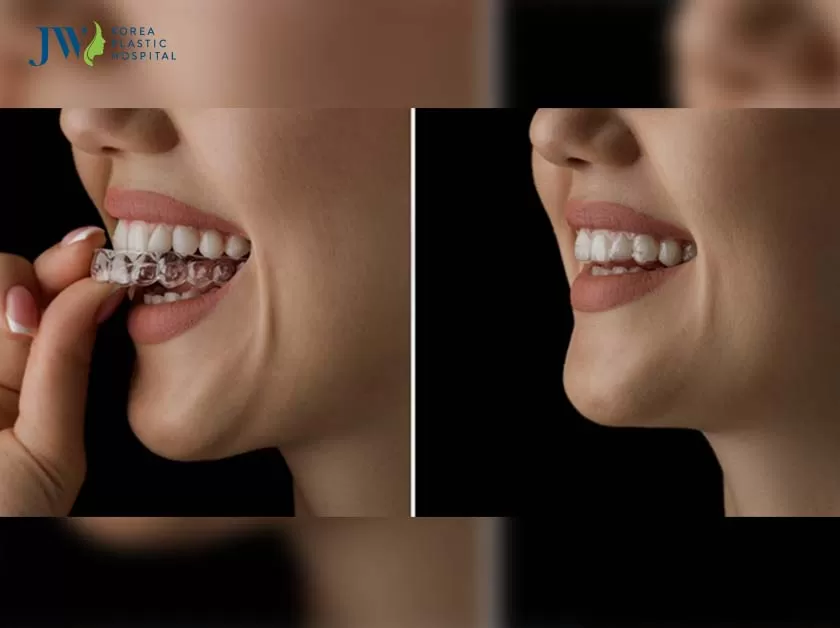 Niềng răng trong suốt AI thoải mái hơn
