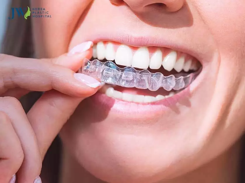 Niềng răng trong suốt AI tiện lợi hơn