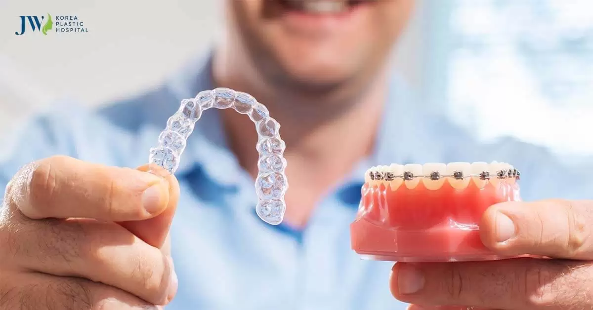 Niềng răng trong suốt AI có gì vượt trội hơn niềng răng mắc cài?