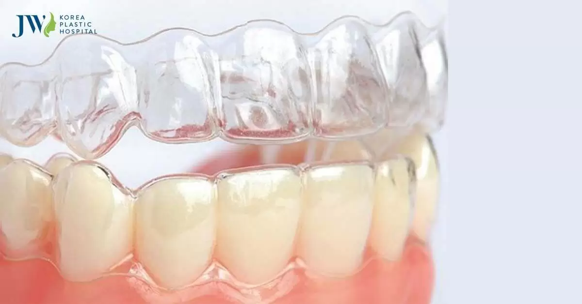 Niềng răng trong suốt AI giá bao nhiêu?
