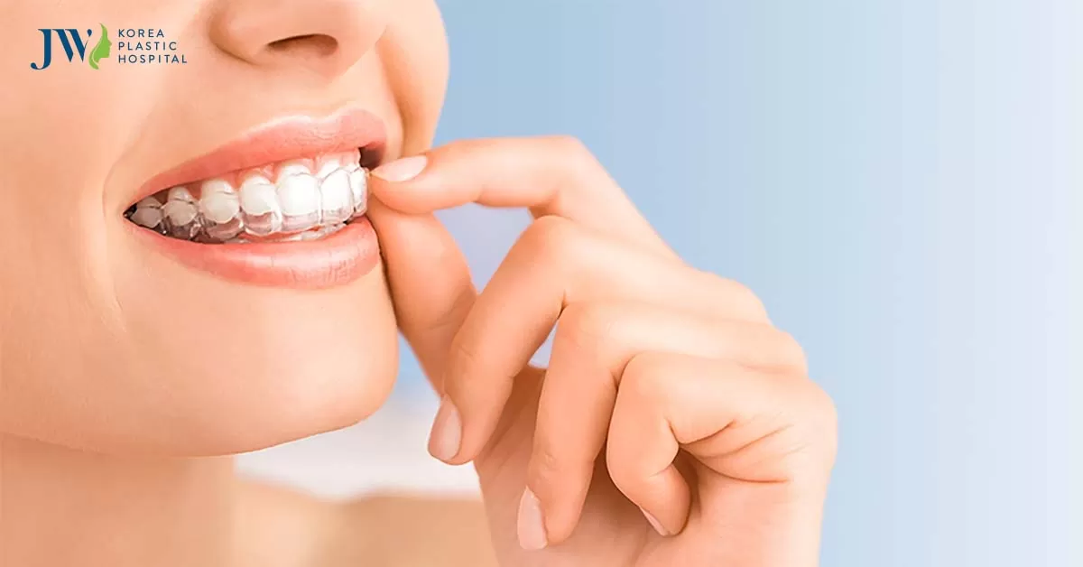 Niềng răng trong suốt AI phù hợp cho đối tượng nào? Lộ trình niềng ra sao?