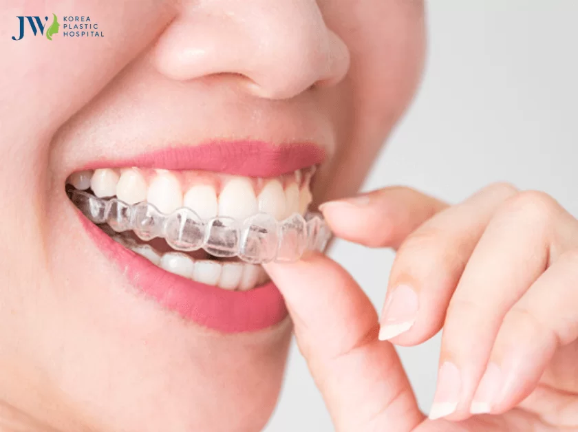 niềng răng trong suốt ai
