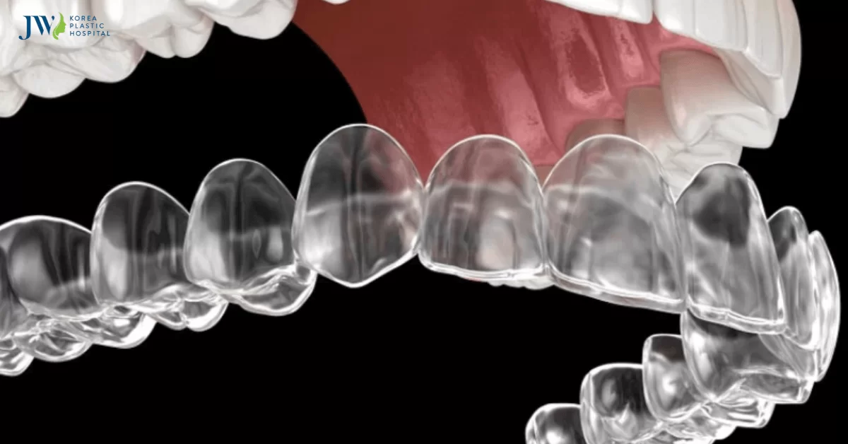 Niềng răng trong suốt AI: Có ăn được không?