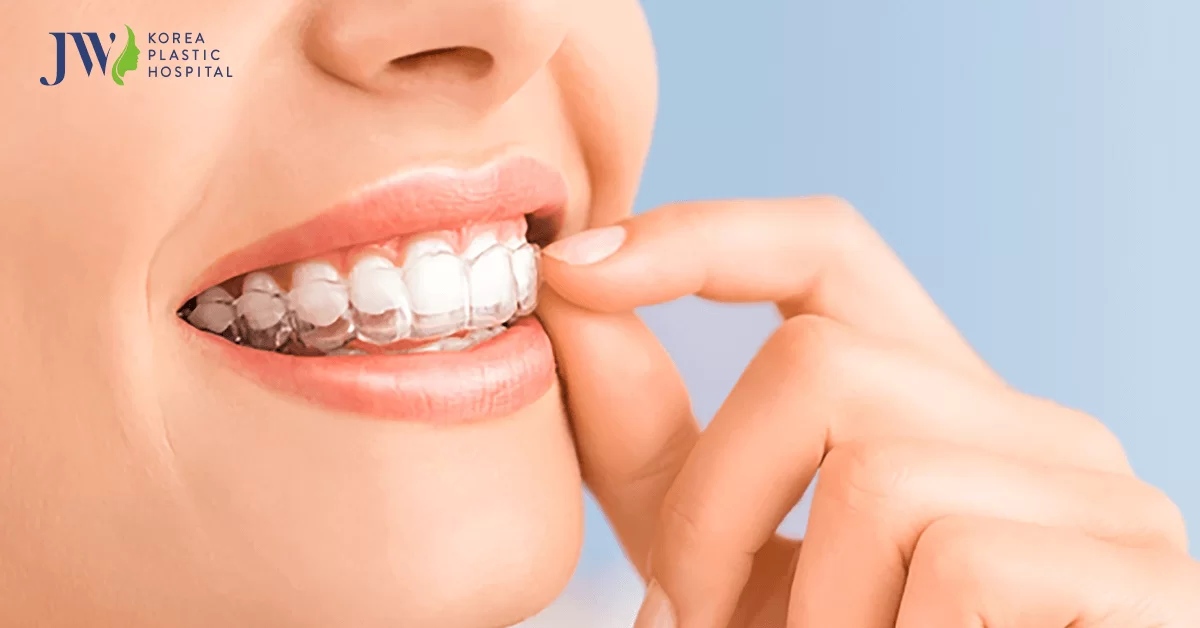 Niềng răng trong suốt AI giá bao nhiêu?