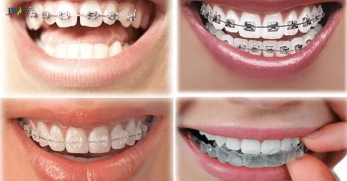 MỘT SỐ PHƯƠNG PHÁP CHỈNH NHA HIỆN ĐẠI NHẤT HIỆN NAY 