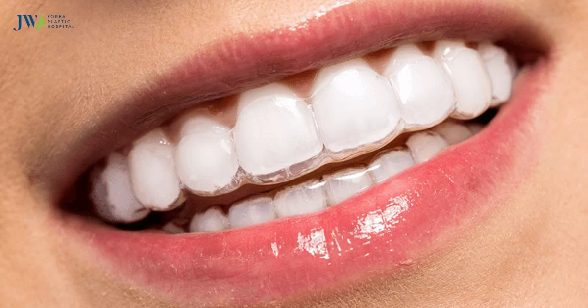 Quá trình niềng răng trong suốt AI và những lưu ý sau đây