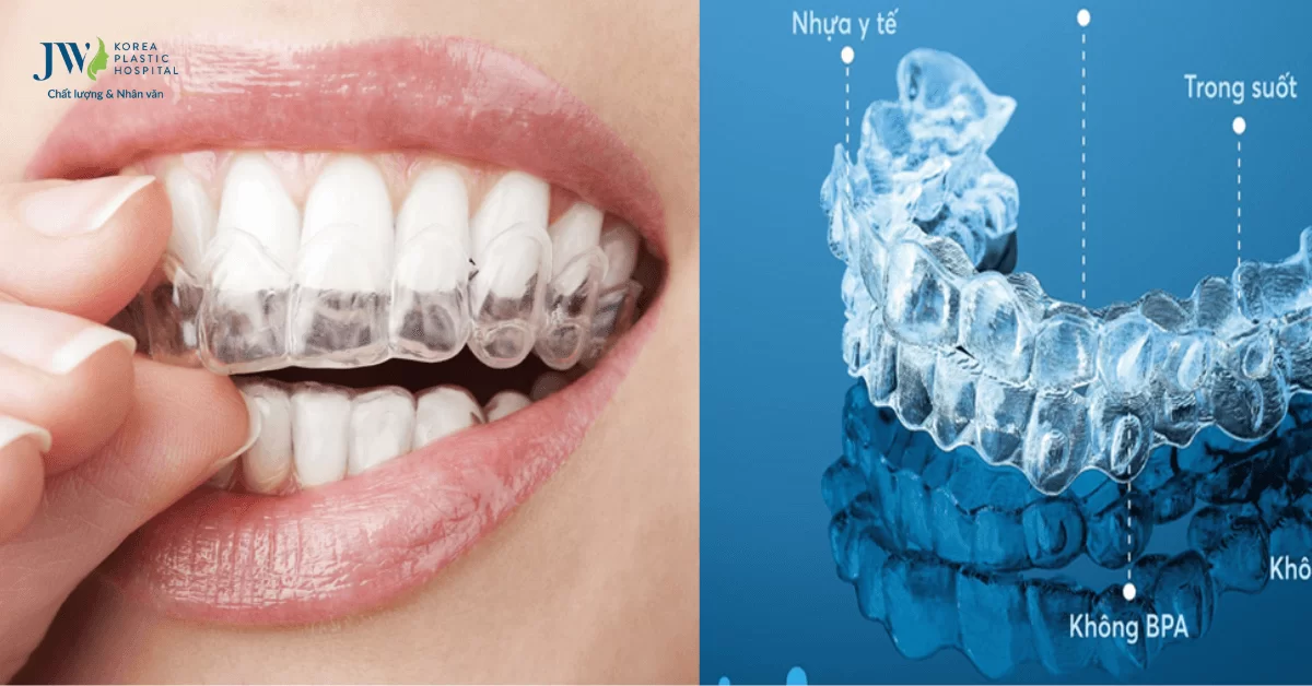 Quy trình niềng răng trong suốt AI