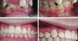 răng yếu có niềng răng được không