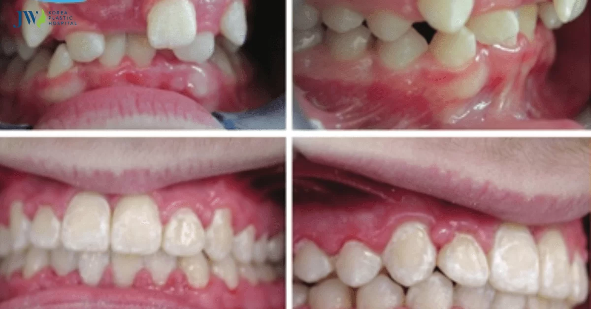 Răng yếu có niềng răng được không?