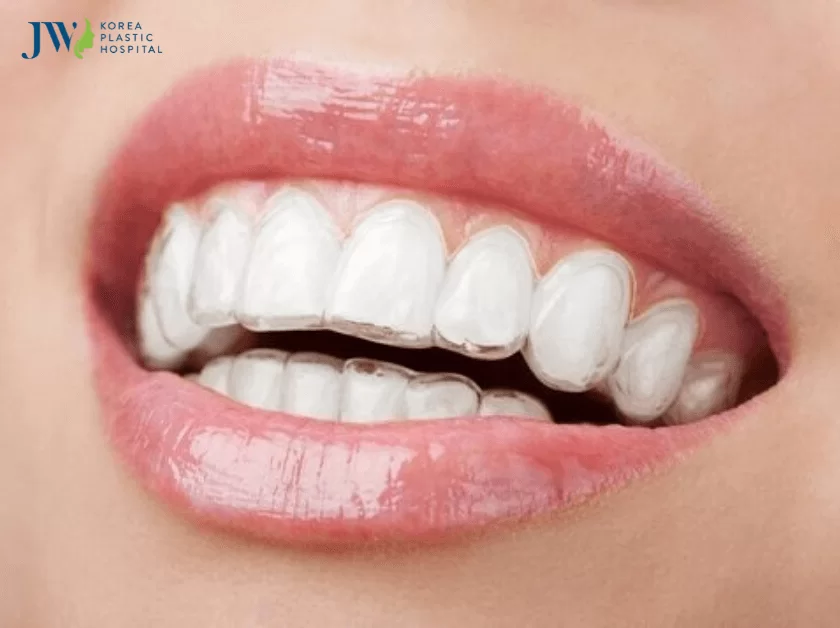 niềng 4 răng cửa được không