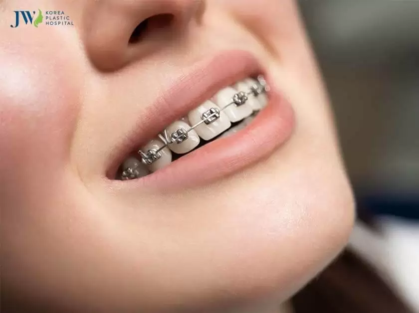 40 tuổi niềng răng được không