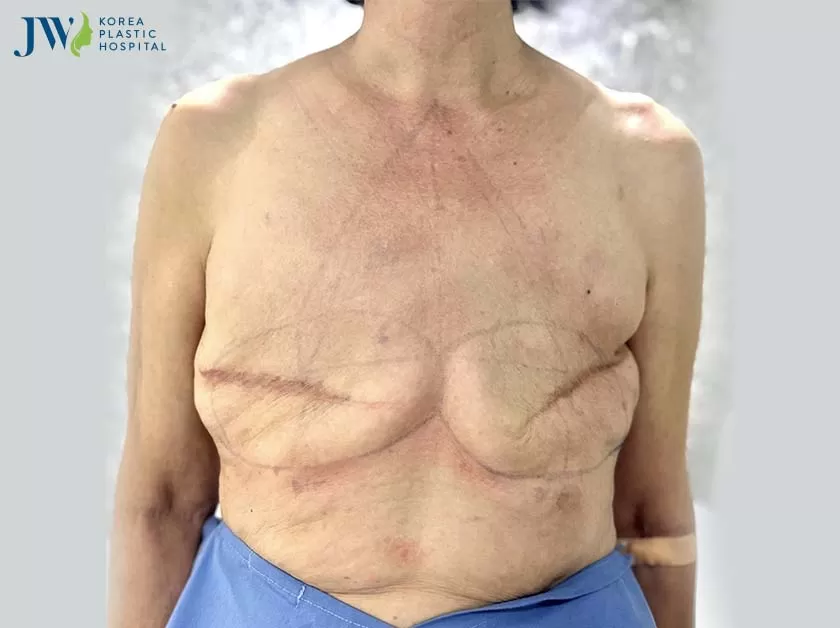 Nữ khách hàng mất hoàn toàn 2 bên ngực