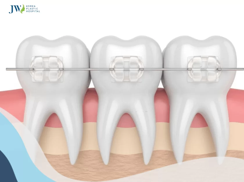 Niềng răng mắc cài sứ trong suốt