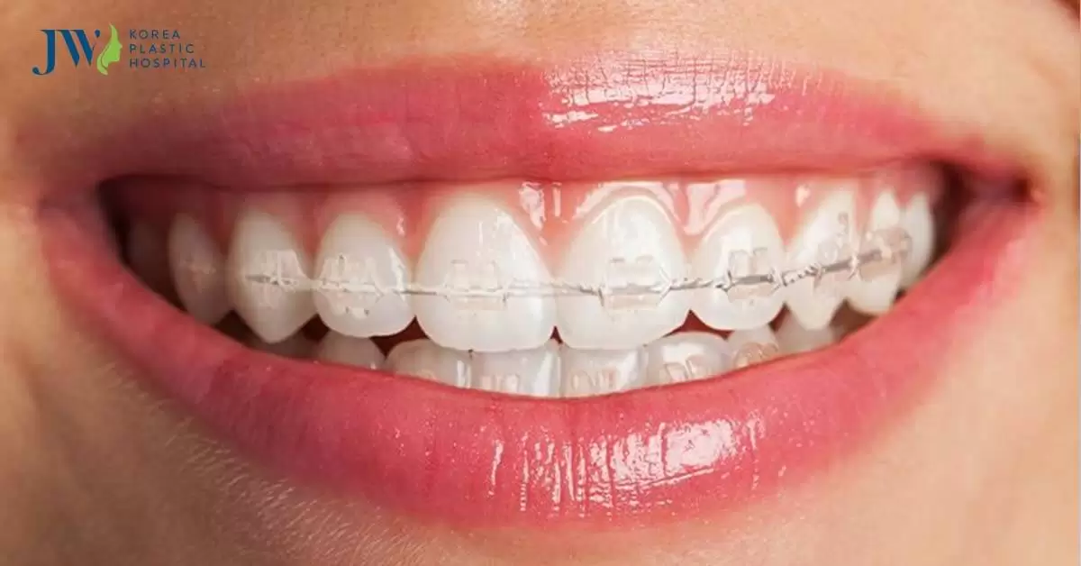 Ưu và nhược điểm của niềng răng mắc cài sứ ít người biết