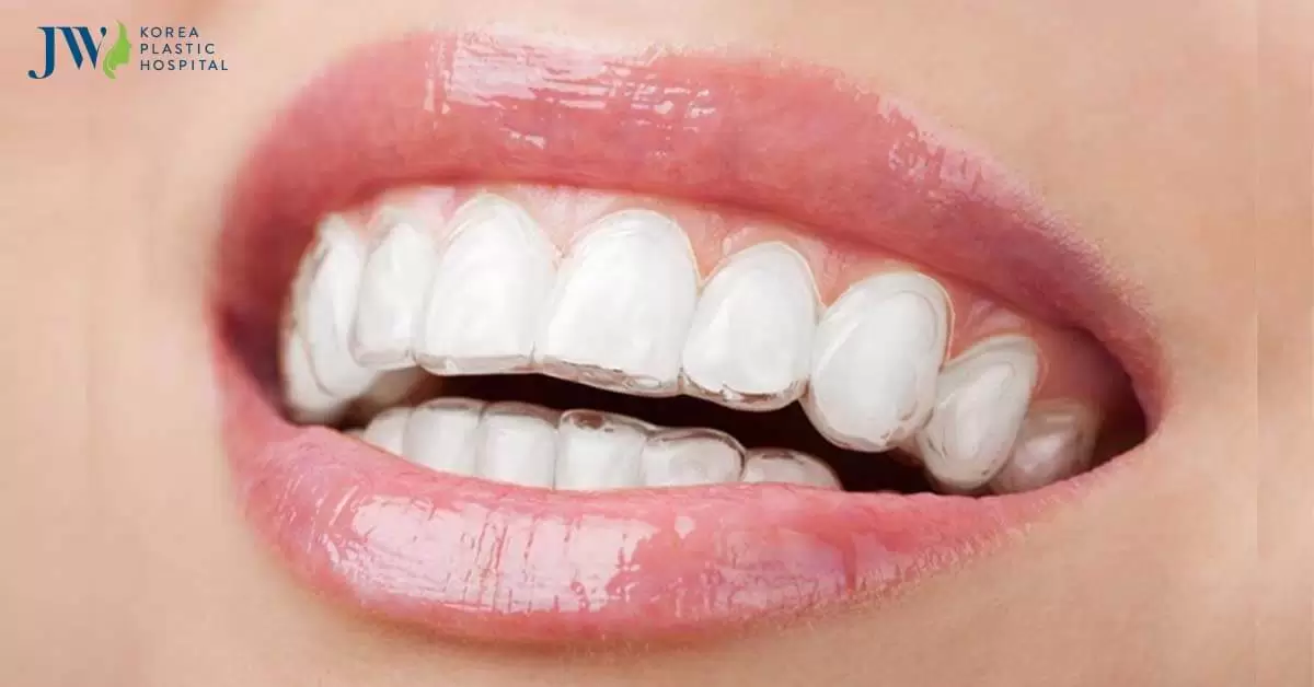 Niềng răng trong suốt AI: Vua công nghệ niềng răng