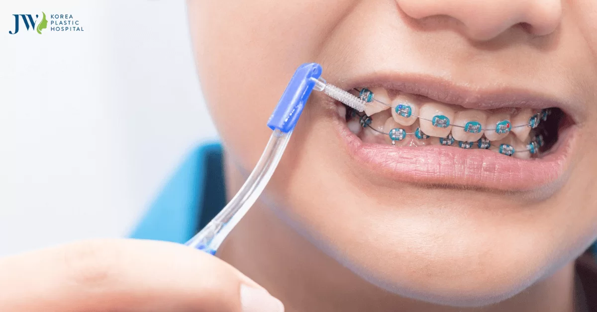 16 tuổi chi phí niềng răng bao nhiêu thế nào? Làm sao để tiết kiệm