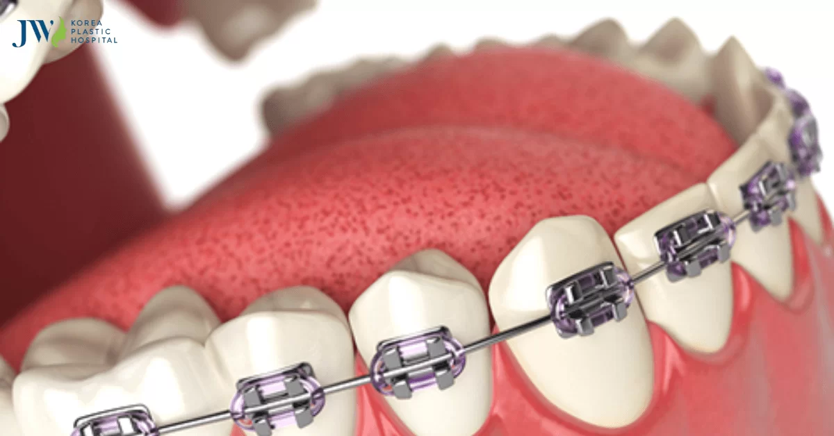 19 tuổi niềng răng bao lâu sẽ hoàn thành? Thời gian chỉnh nha thế nào?