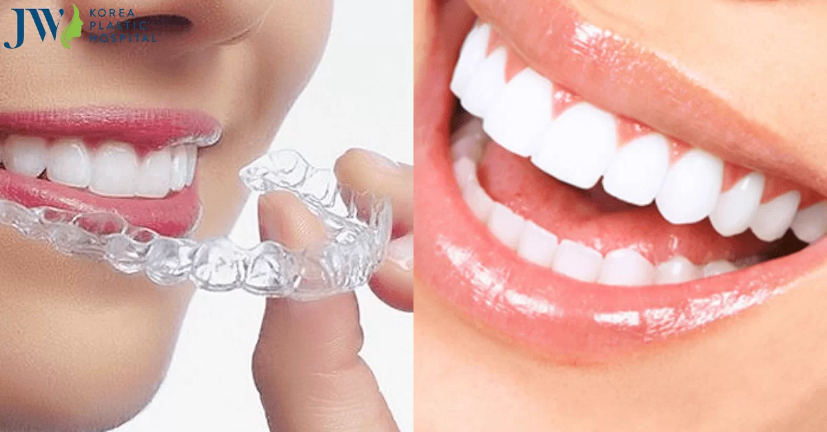 Nên lựa chọn niềng răng hay bọc sứ?