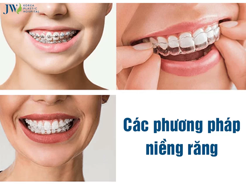 25 tuổi có niềng răng được không?